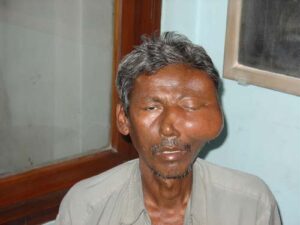 A patient with a sarcoma condition on the zygoma | This condition can be cured with homoeopathy remedy and treatment